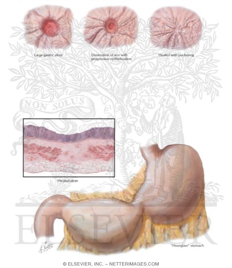 Peptic Ulcer IX - Healing of Gastric Ulcer