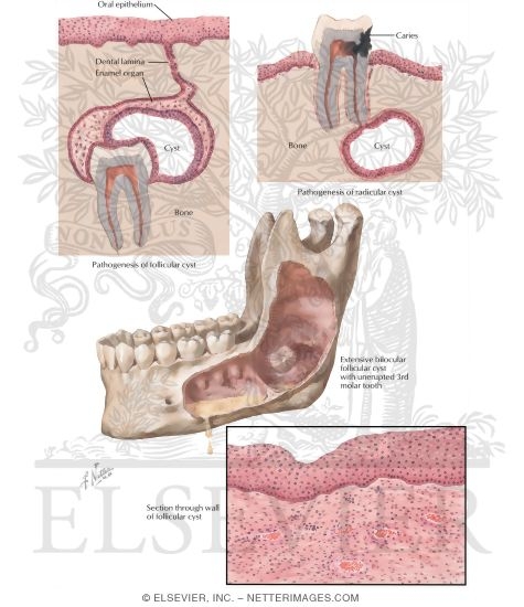 Jaw Cyst Picture