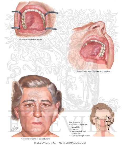 Malignant Tumors II