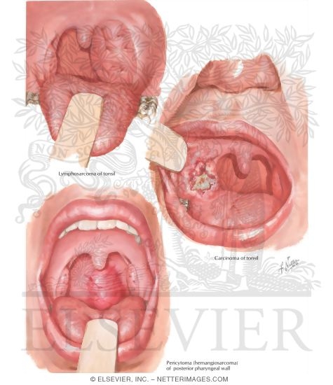 Malignant Tumors of Fauces and Oral Pharynx