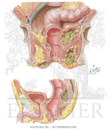 Anorectal Abscess Images