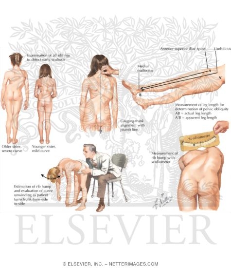Clinical Evaluation of Scoliosis