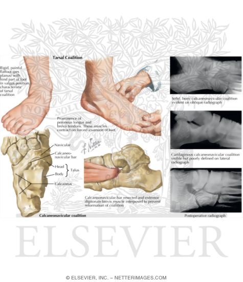 Tarsal Coalition