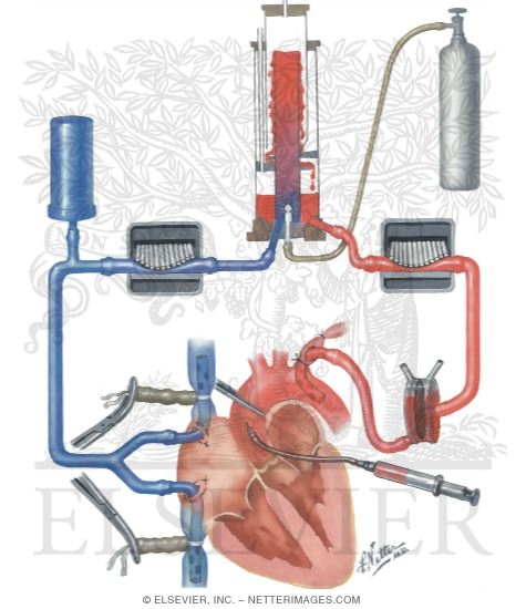 Heart-Lung Machine