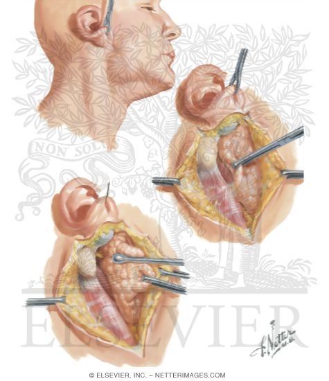 parotid tumor surgery