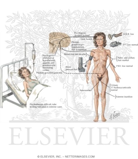 Anorexia Nervosa