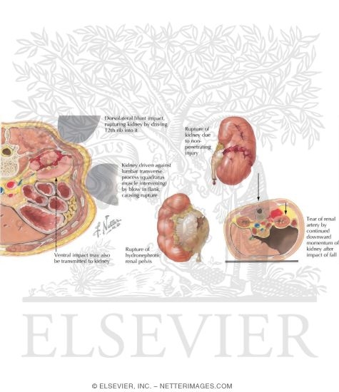 Renal Trauma: Nonpenetrating Trauma of Kidney