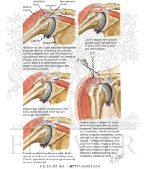 Tendonitis and Bursitis of Shoulder