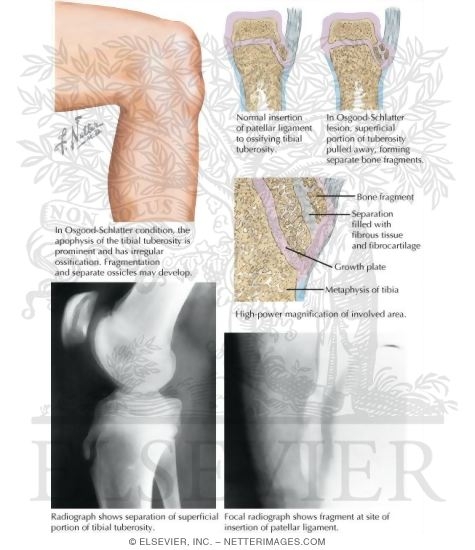 Osgood-Schlatter Lesion