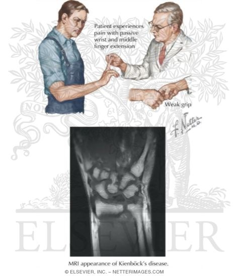 Kienbock's Disease
