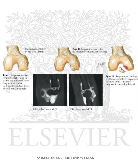Progression of Osteochondritis Dissecans
