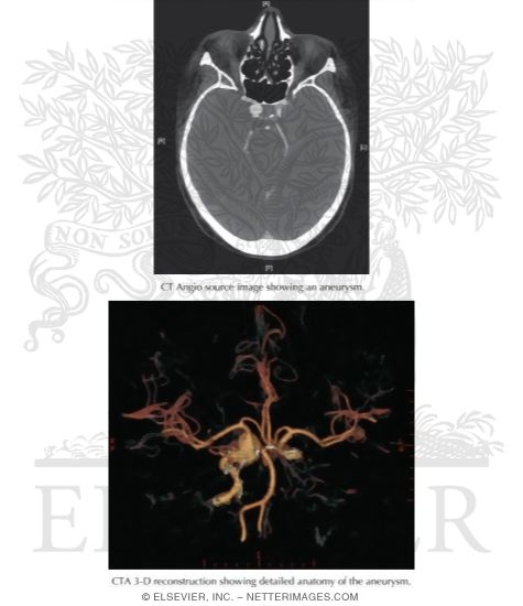 Subarachnoid Hemorrhage