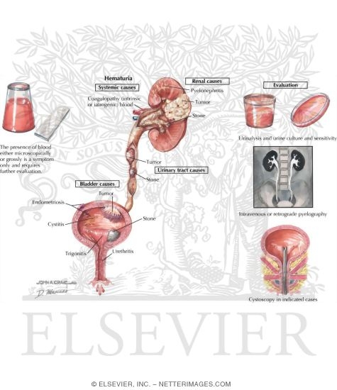 Hematuria