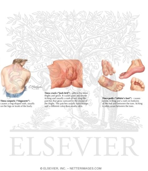 Tinea Infections