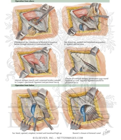 Hernia II - Femoral Hernia