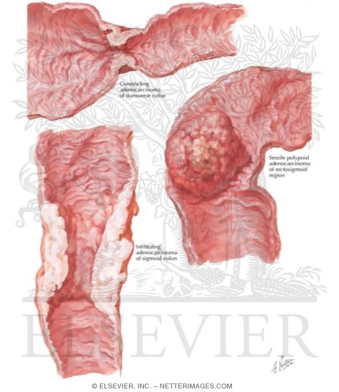 Malignant Tumors of Large Intestine