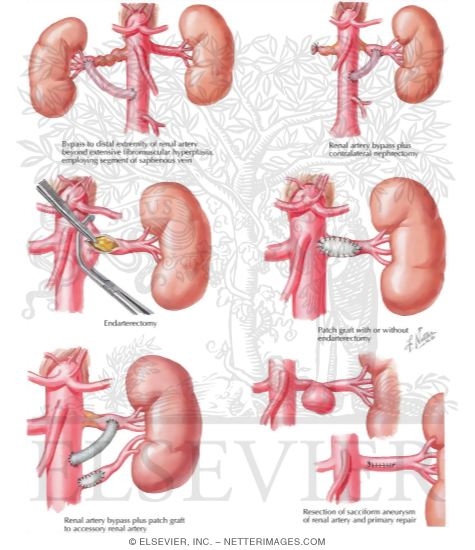 Renal Revascularization