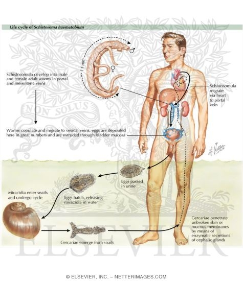 Urinary Schistosomiasis