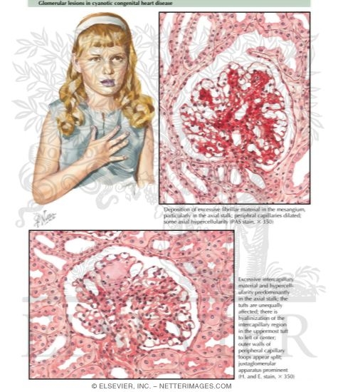 Glomerular Lesions in Cyanotic Congenital Heart Disease