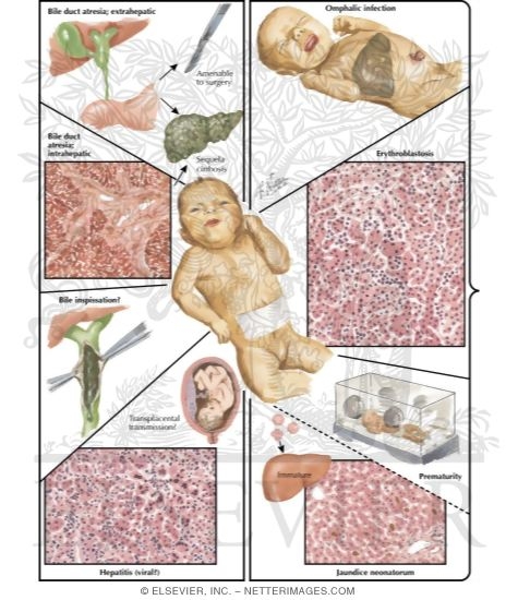 Jaundice in the Neonatal Period
