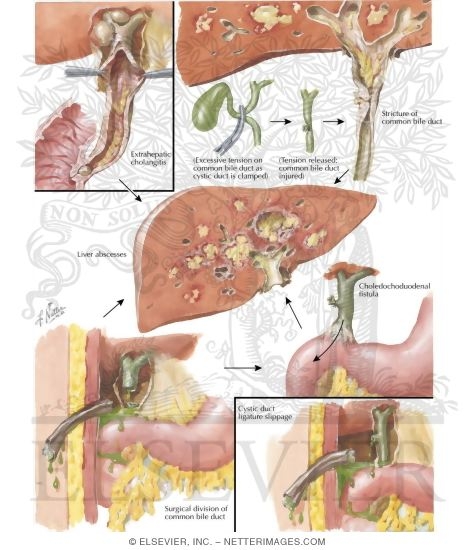 Extrahepatic Cholangitis, Strictures, Surgical Accidents