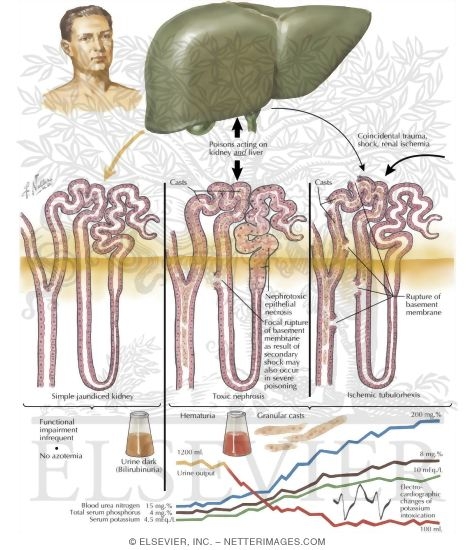 Renal Complications of Liver Disease