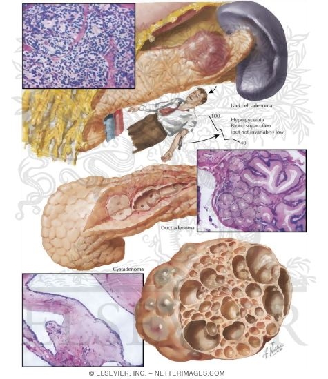 Benign Tumors