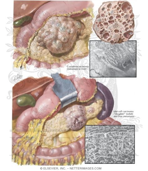 Malignant Tumors I - Cystadenocarcinoma, Islet Cell Carcinoma