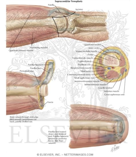 Amputation of Lower Extremity