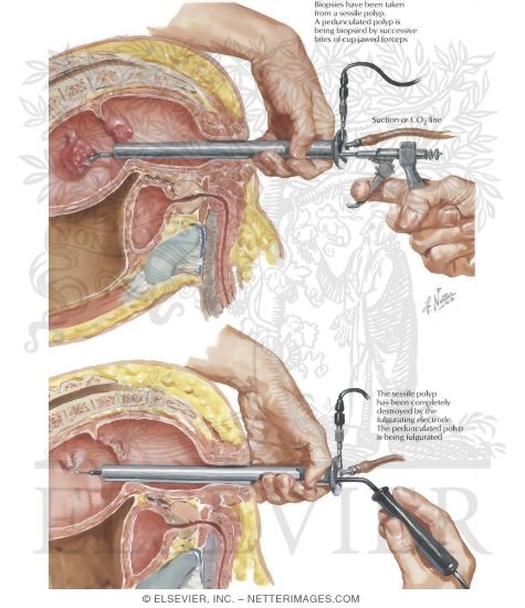 Removal of Polyps