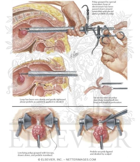 Removal of Polyps