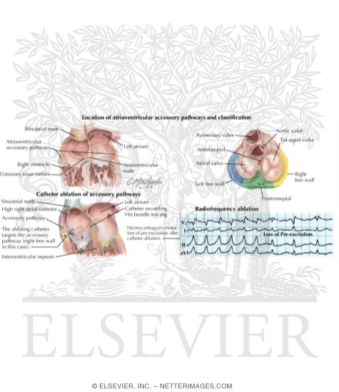 Accessory Pathways and the Wolff-Parkinson-Whate Syndrome
