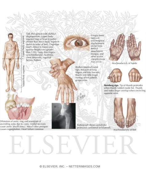 Characteristics of Marfan Syndrome