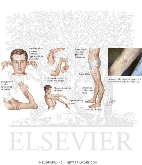 Figure 35-2 Characteristics of Ehlers-Danlos Syndrome. (Photograph ...