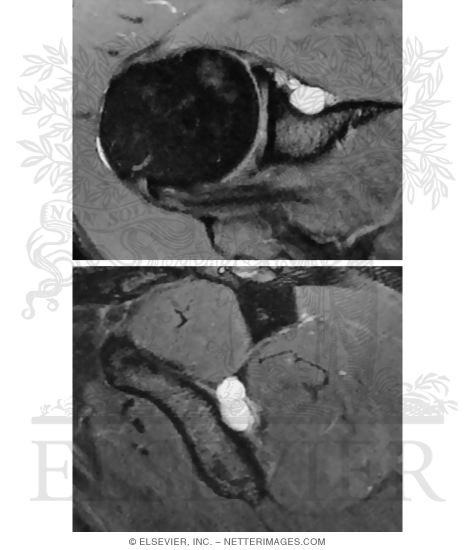 Spinoglenoid Cyst
