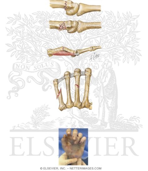 Metacarpal Fracture