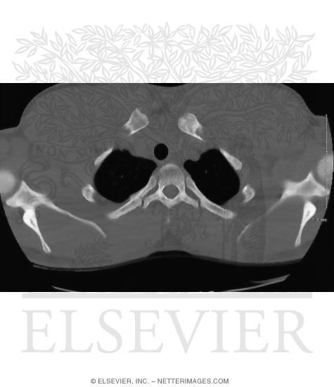 Posterior Rib Fracture