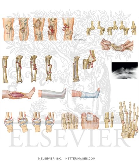 Lower Extremity Fractures and Dislocations