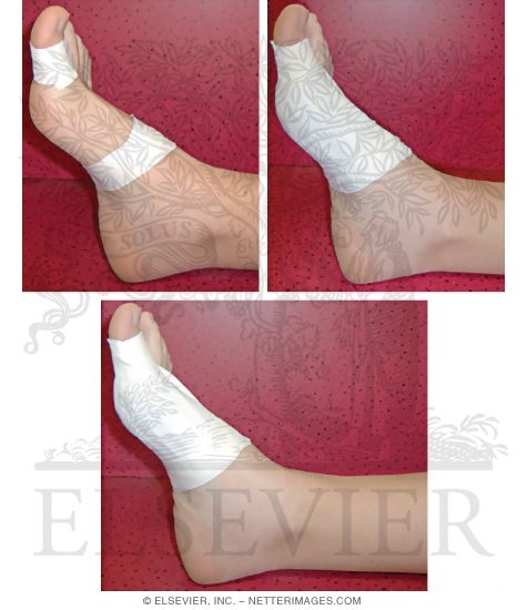 Taping Procedures: Turf-Toe Taping