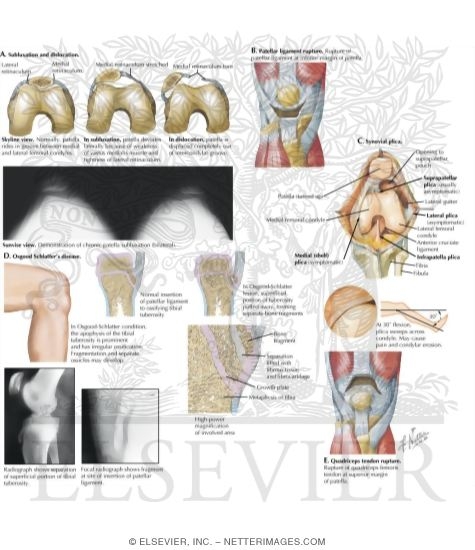 Extensor Mechanism Problems