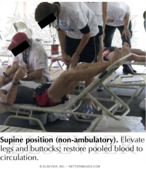 Fluid Replacement and Redistribution After Exercise-Associated Collapse