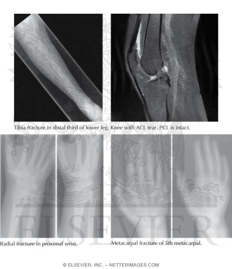 Common Injuries In Field Hockey