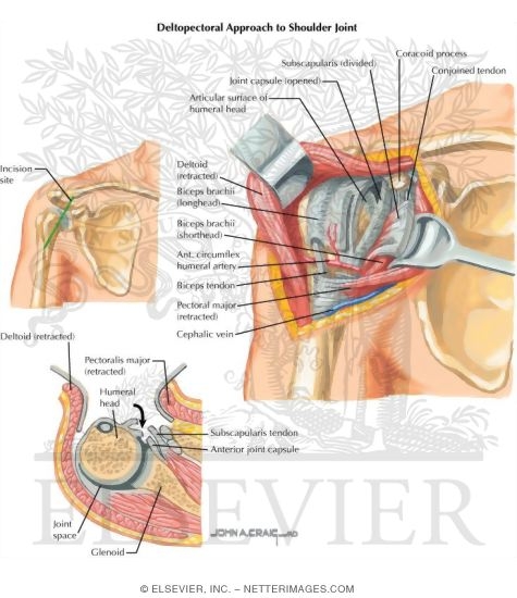 Deltopectoral Approach to Shoulder Joint