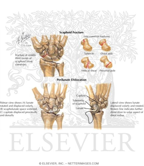 Scaphoid Fracture