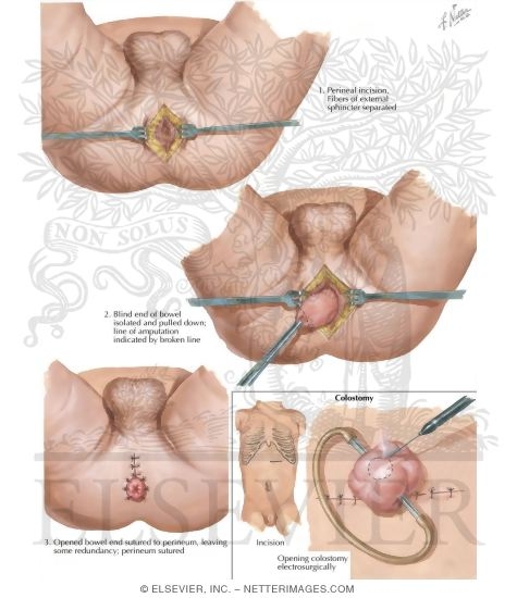 Mature galleries and mommy boy stories Laparoscopic repair high imperforate anus