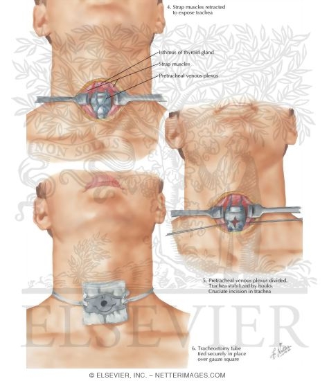 Tracheotomy II