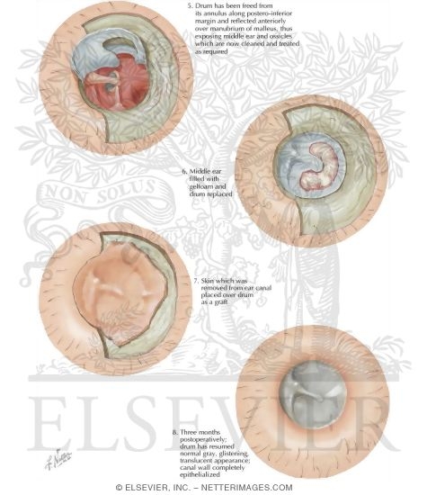 Transmeatal Tympanoplasty