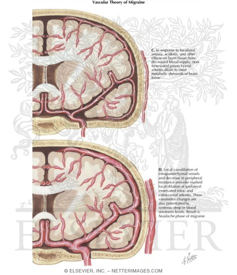 Theory of Migraine Etiology