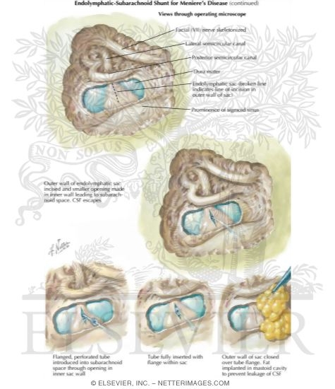 Decompression: Endolymphatic Sac Decompression