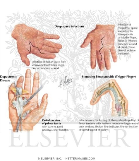 Disorders of the Hand